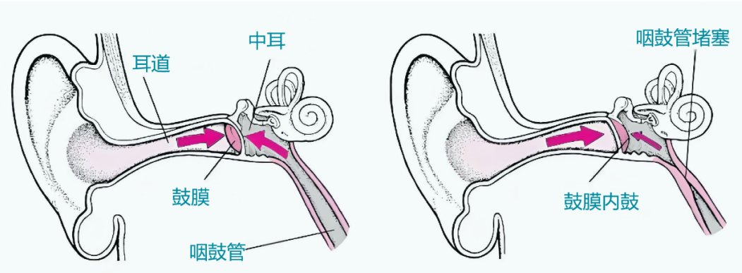 博闻｜咽鼓管功能检查：打开耳部健康的另一扇窗（一）(图6)