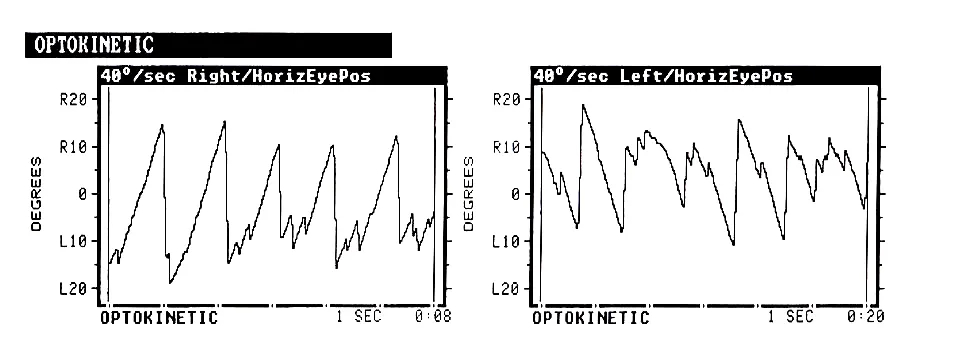 博闻 | VNG眼震视图检查(四)视动试验(图8) 博闻 | VNG眼震视图检查(四)视动试验(图8)