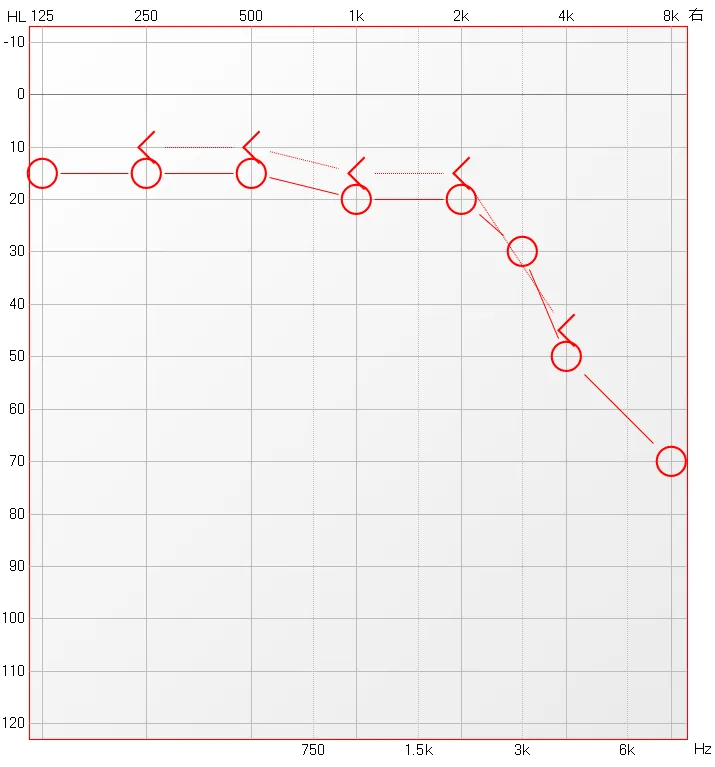 博闻 | 熬夜后耳鸣、听不清?警惕突发性耳聋!(图11) 博闻 | 熬夜后耳鸣、听不清?警惕突发性耳聋!(图11)